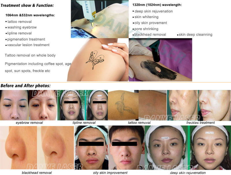 ND YAG Laser Tattoo Remover Carbon Skin Peeling Tattoo Remove Machines