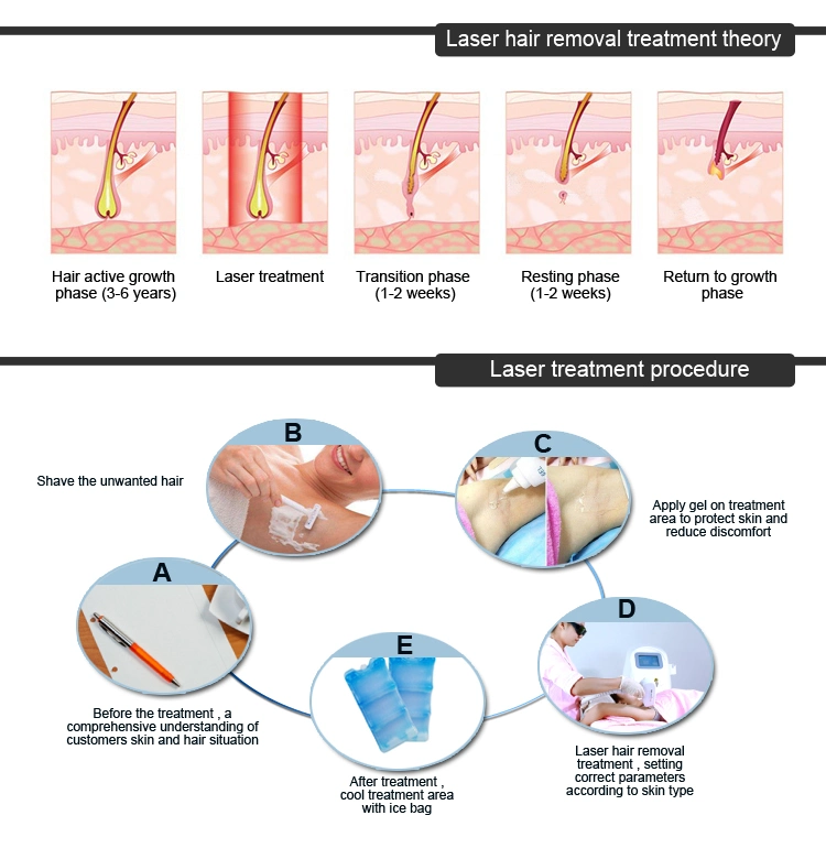 Permanent Hair Loss Portable 808nm Diode Laser Hair Removal Laser Diode with Ce
