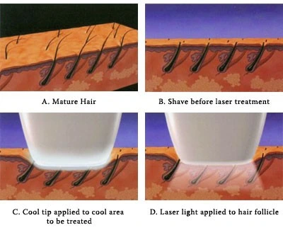 Medical Ce Diode Laser 808 Nm Skin Rejuvenation Laser Machine Laser Hair Removal