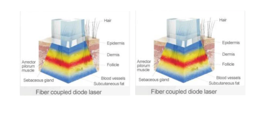 Newest Best Diode Laser 808 Maquina De Depilacion Laser/ Fiber Coupled