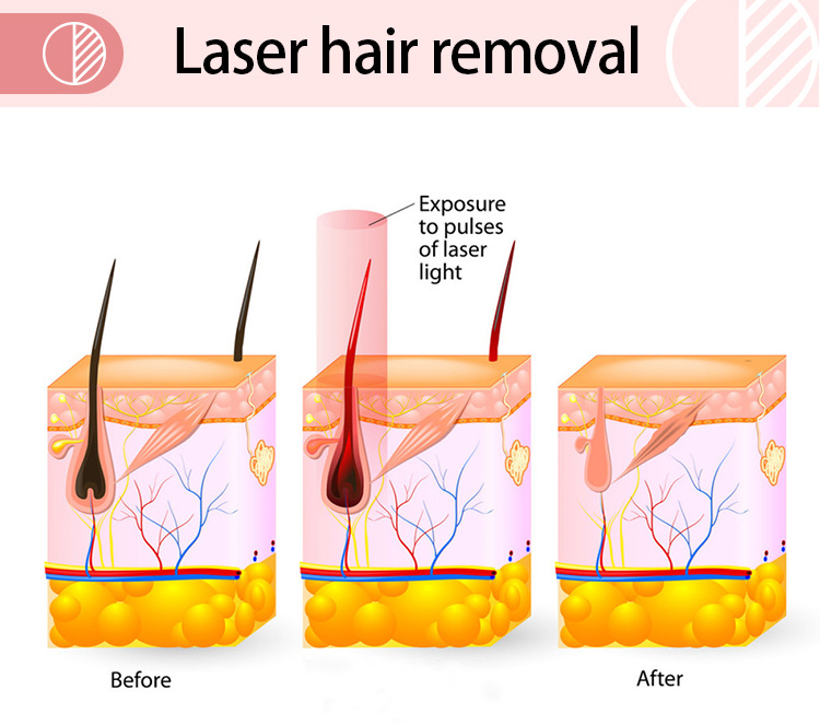 755nm 808nm 1064nm Diode Laser