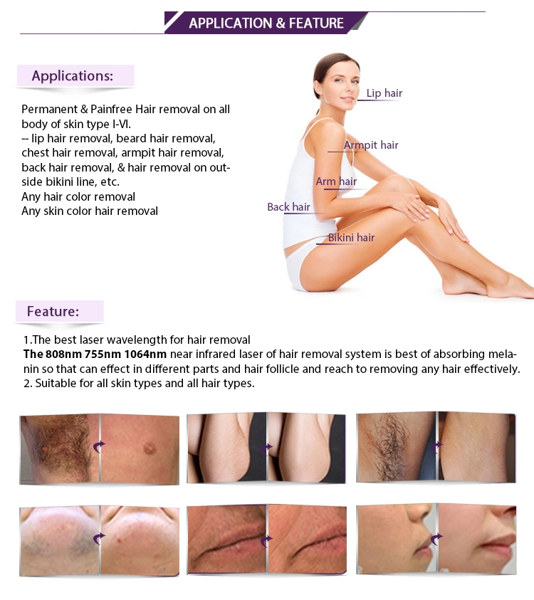 Beauty/Medical/Salon/Clinic/Skin Care/755 808 1064nm Diode Laser Machine for Hair Removal