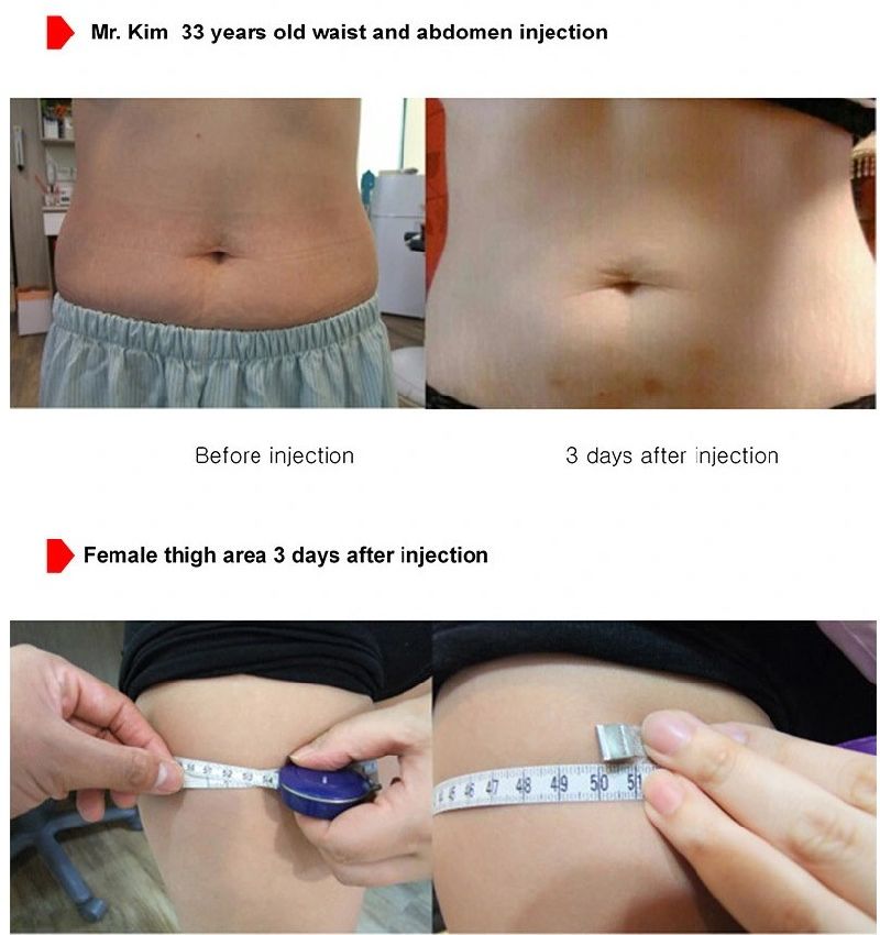 General The Red Ampoule Solution Korea Dissolve Fat Injection Lipolysis