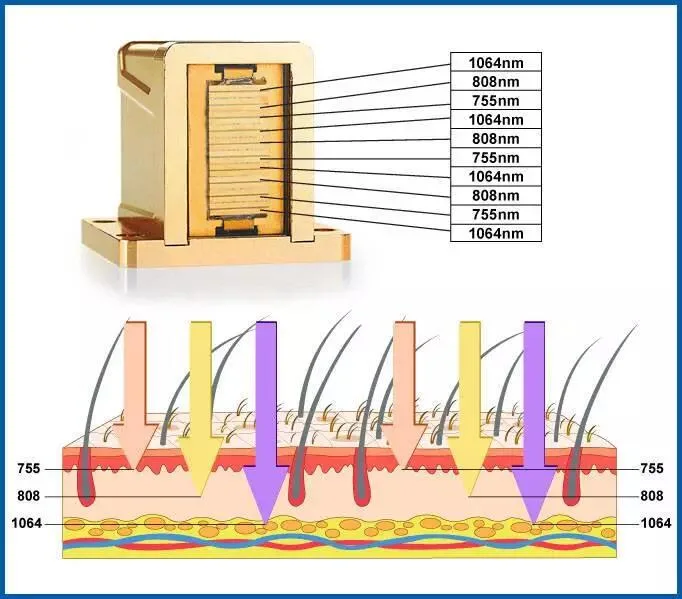 Professional Hot 3 in 1 Diode Laser Hair Removal Device with Alex Diode YAG Laser 755 1064 808