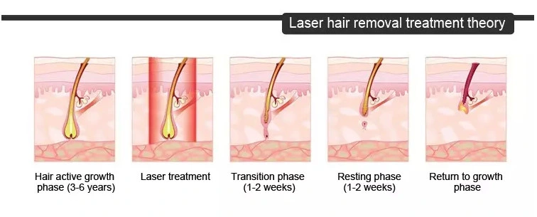 Painless Portable Laser Remove Hair 808nm Diode Laser