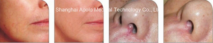 Apolo Aesthetic Treatment with 15W/30W Output 980 Diode Laser Beauty Equipment HS-890