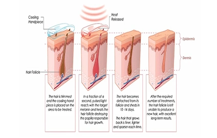 IPL Hair Removal Diode Laser 808nm