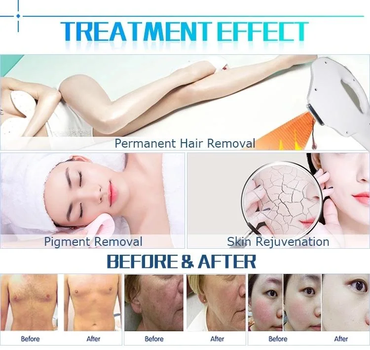 Ce Approved Best Professional Hair Removal IPL Handpiece E Light IPL Laser Machine for Sale