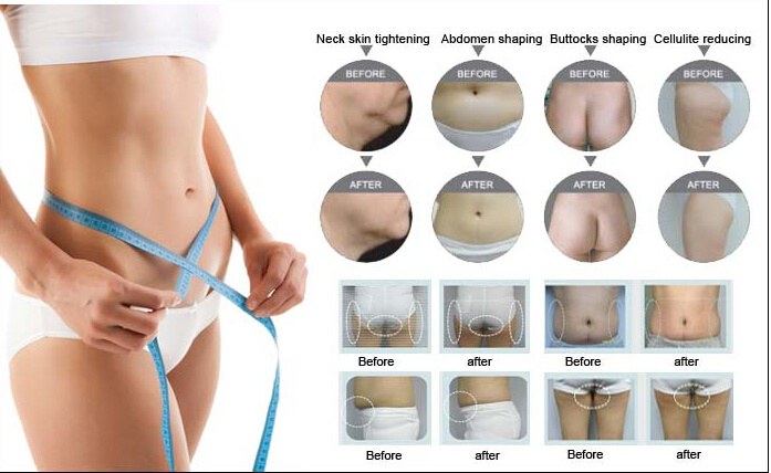 Hot Ultrasonic Cavitation RF Cellulite Slimming Body Shaping Machine