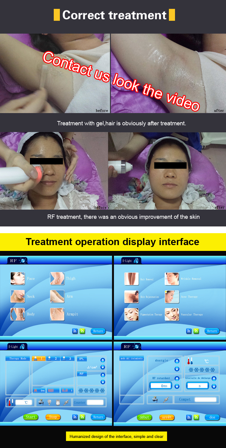 Portable Opt IPL Shr Hair Removal RF Skin Tightening Beauty Machine