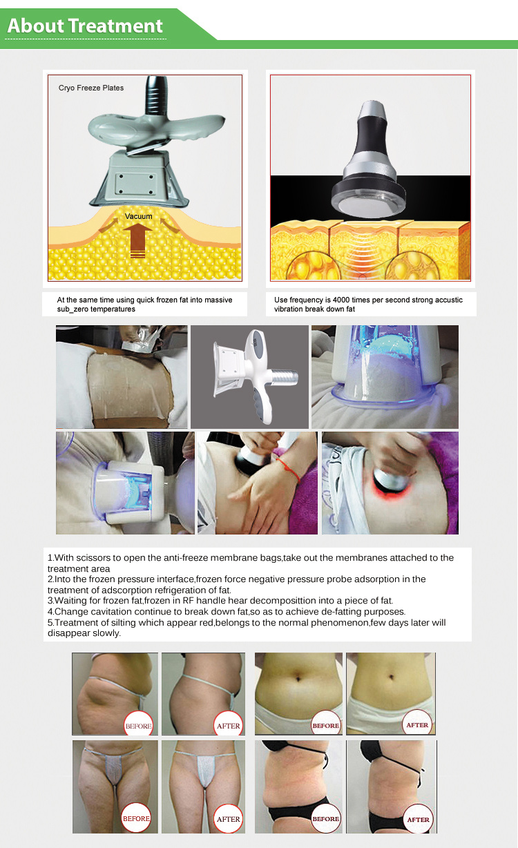 Favorable Price Cryolipolysis Body Slimming Ultrasound Cavitation Machine