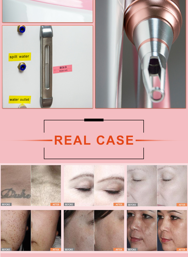 IPL+RF+E Light+Picosecond Laser Skin Rejuvenation Tattoo Beauty Machine