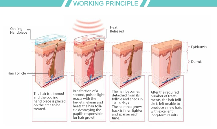 808nm Laser Diode Hair Removal Alexandrite Laser Factory Price