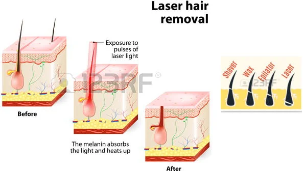 808 Hair Laser Removal Diode Laser Hair Removal Machine Laser