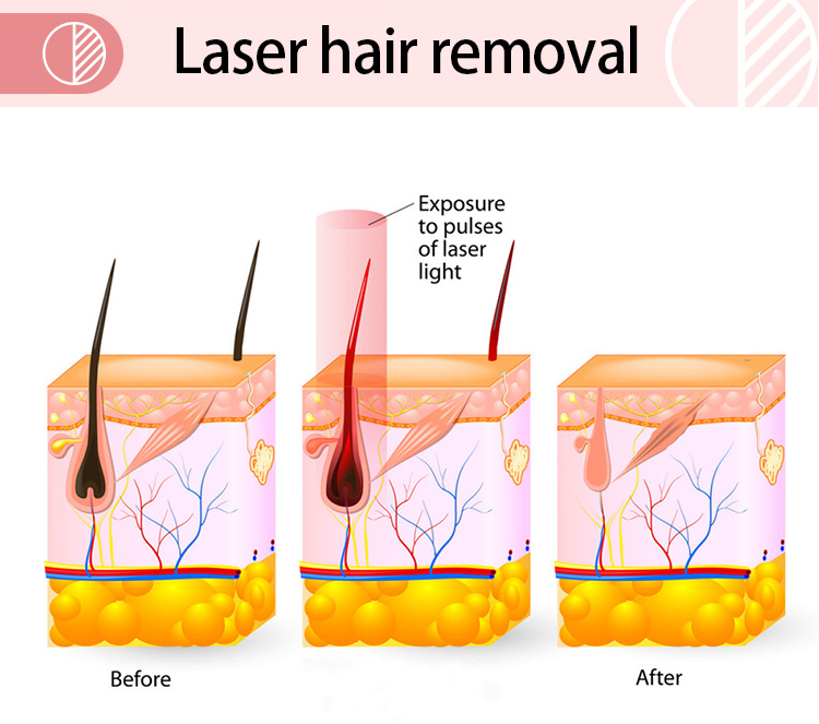 New Design Diode Laser 808nm for Hair Removal