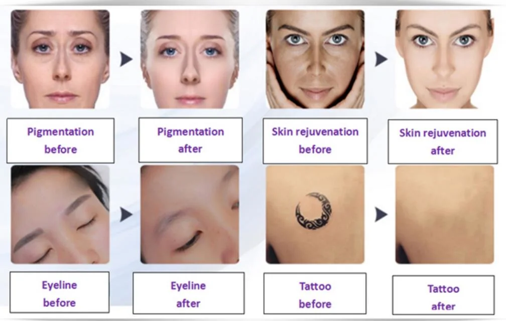 Tattoo Removal and Pigment Removal Q-Switched ND YAG Laser Picosecond