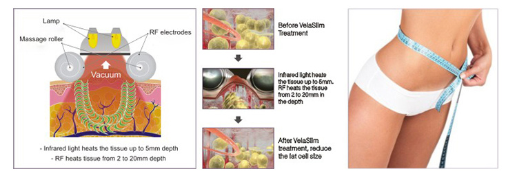 Hot Sales Vacuum Roller Velashape Slimming Machine for Fat Reducing