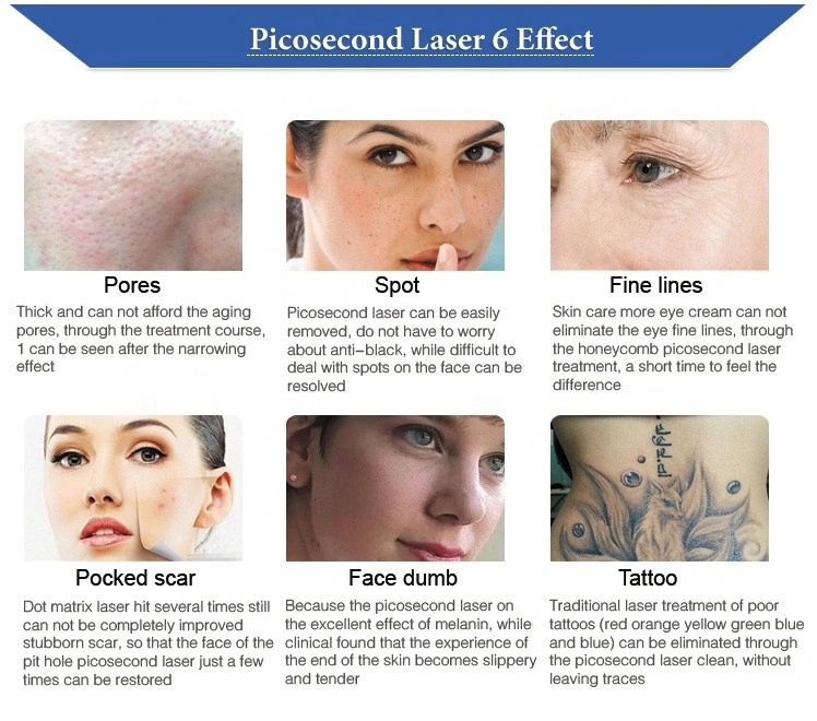 Professional Picosure Laser Freckle Spots Tattoo Removal Machine