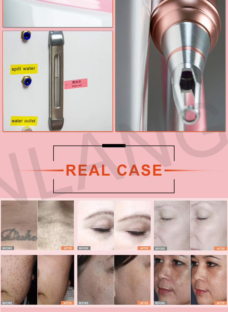 Renlang Multifunction Shr+Elight+IPL Opt Super Hair Removal RF E Light IPL Laser Machine