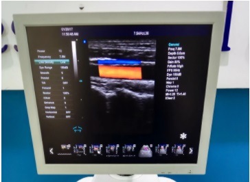 Ultrasound Doppler Ultrasound Ultrasound Ultrasound Machine P9 Doppler Trolley Ultrasound