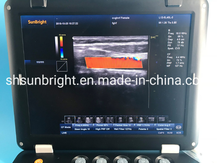 Colorful Ultrasound Scanner Doppler Color Ultrasound Sun-906A Medical Ultrasound Scan