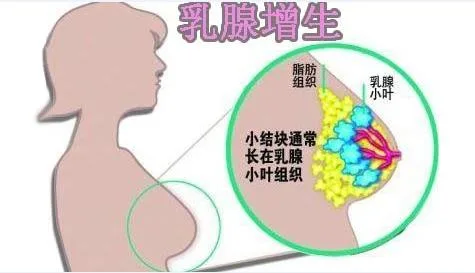 Mammary Gland Patch Breast Pain Relife Patch, Breasts Become Beautiful