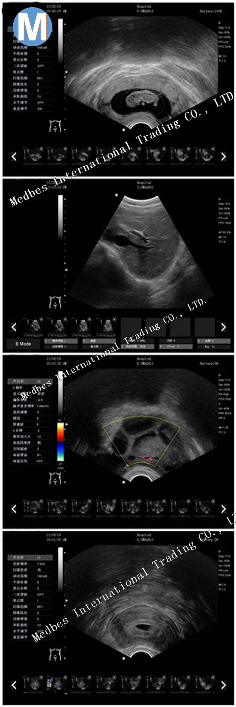 Children Used Portable Ultrasound Bone Densitometer