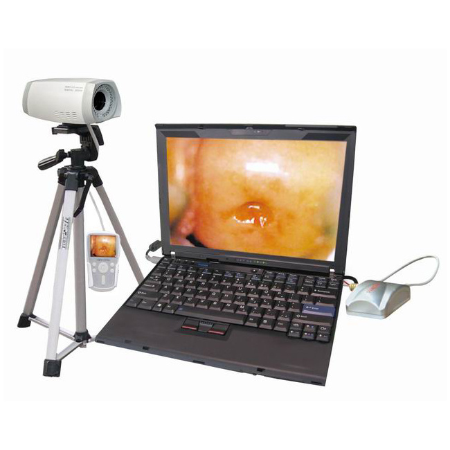 Clinical Digital Laptop Colposcope/Portable Colposcope for Vagina