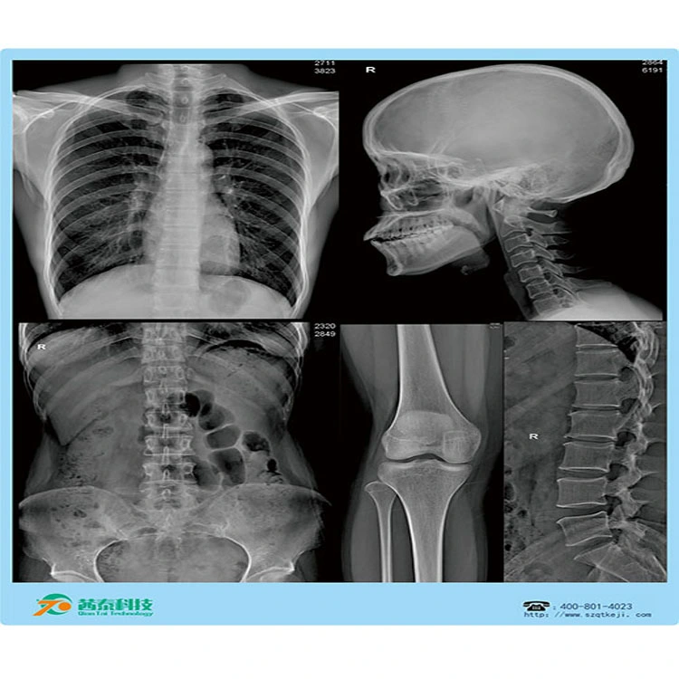 27*35cm Printing Radiology Universal Medical Thermal Hospital Blue Xray Film