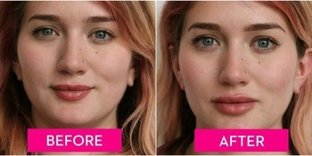 Facial Dermal Filler 2ml Injectable Dermal Injection Filler for Lips