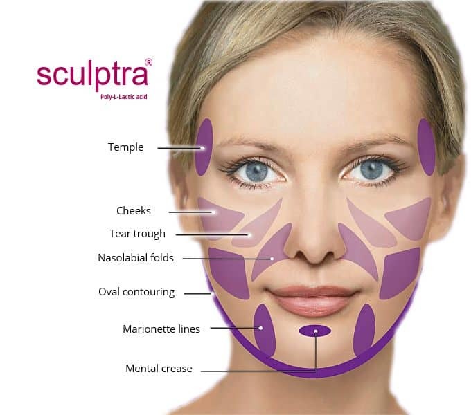 Sculptra Aesthetic Injetable/Sculptra Lift Derm/Sculptra Lift Dermal Filler