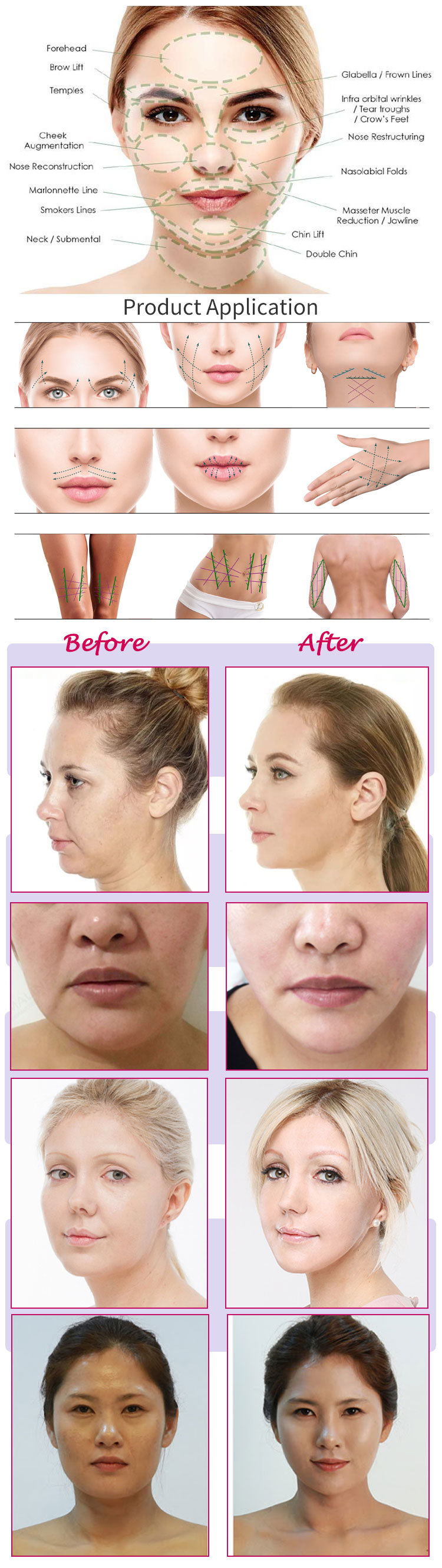 Disposable Face Lifting Pdo Thread for Skin Rejuvenation and Lifting