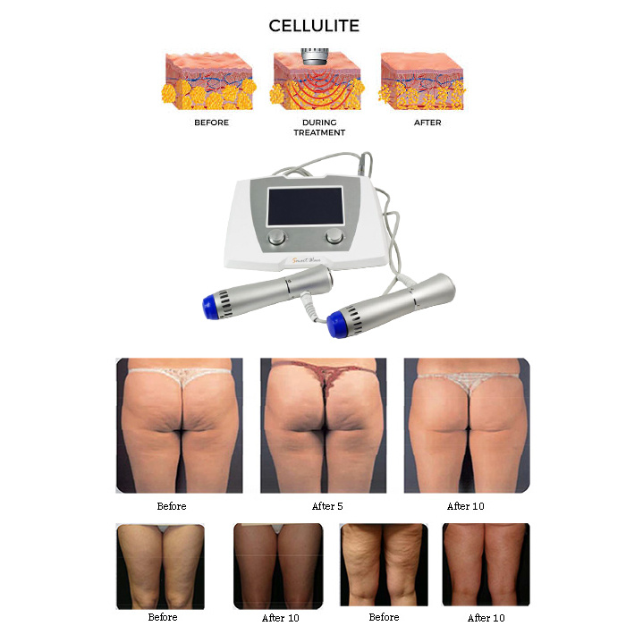 Radial Shockwaves Cellulite Therapy System