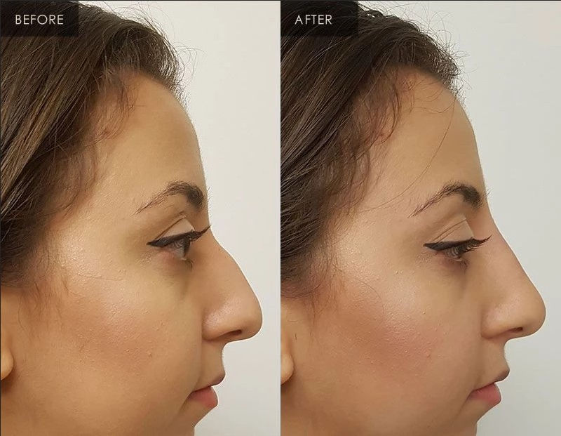How Much Does It Cost for Lip Enhancement and Lips Augmentation with Ha Dermal Fillers