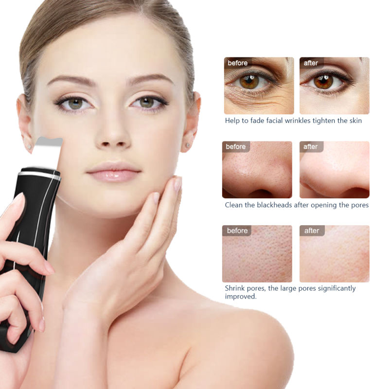 Custom Wholesale Blackhead Removal Pores Cleanse Ultrasonic Skin Scrubber Manufacturer