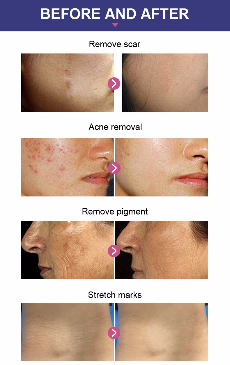 Best Result Fractional CO2 Laser Vaginal Tightening Device RF Tube Fractional Laser Instrument