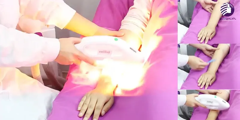 Diode Laser Depilation Device/808nm IPL Laser Depilation Machine