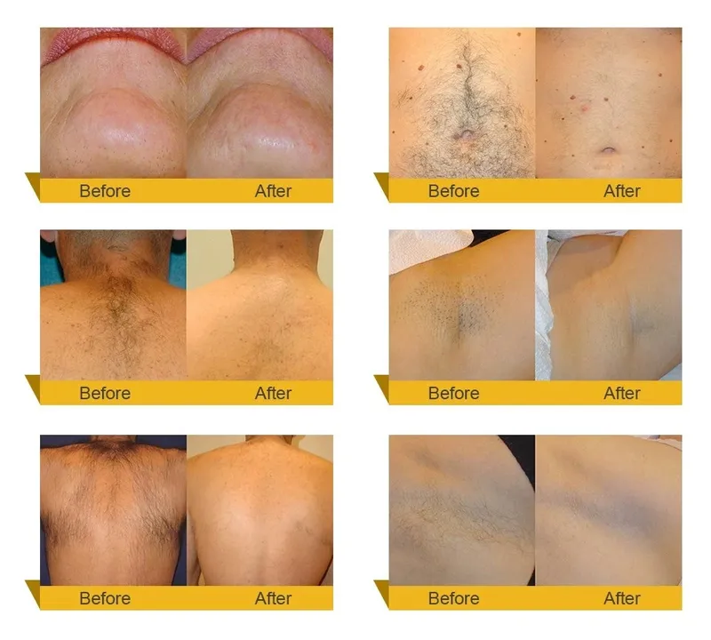 FDA Ce Approved 808nm Diode Laser Hair Removal Machine/Alexandrite Laser Hair Removal