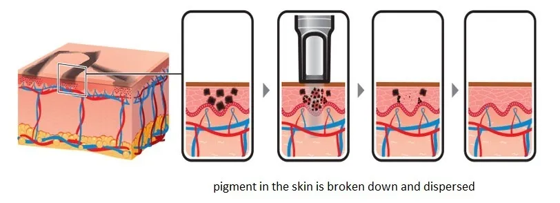 Q Switch ND YAG Pico Laser CE Approved Picosecond Laser Tattoo Removal Machine Pigment Removal