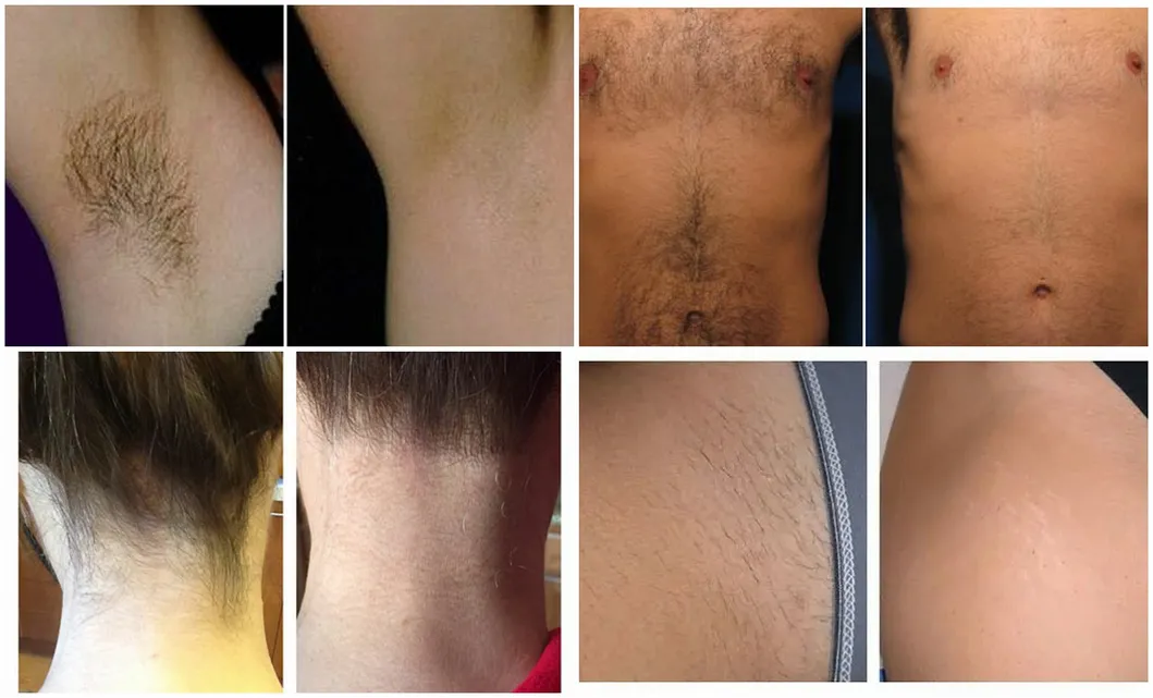 Sincoheren High Power 1200W Diode Laser Permanent Hair Removal Machine