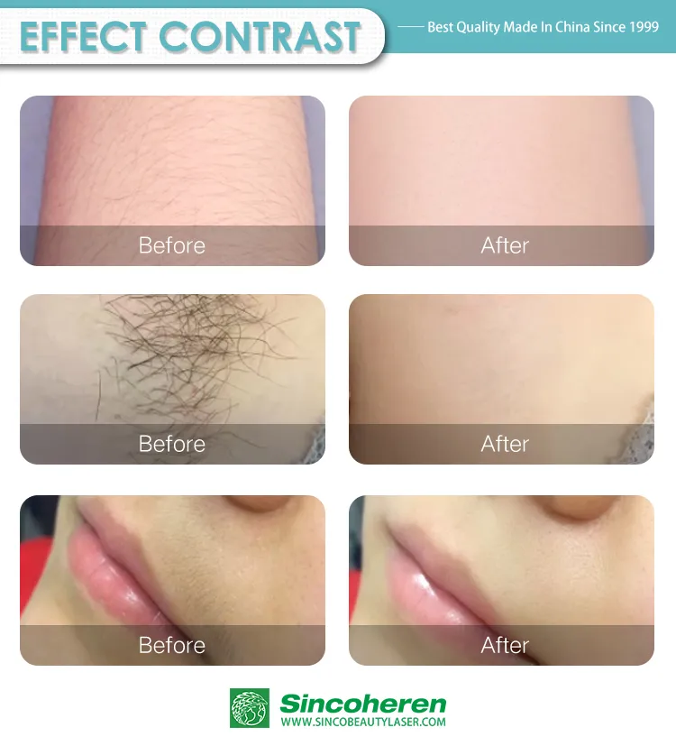 2020 Triple Wavelengths 808 1064 755 Diode Laser Hair Removal