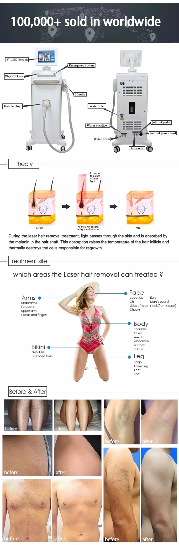 Shr Laser Hair Removal Cooling 808 Diode Laser Machine