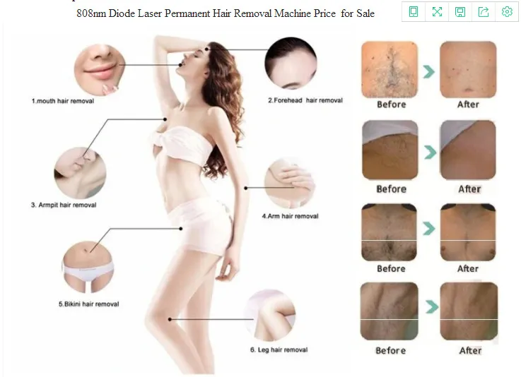 Professional Permanent 810nm Diode Laser Hair Removal Beauty Equipment