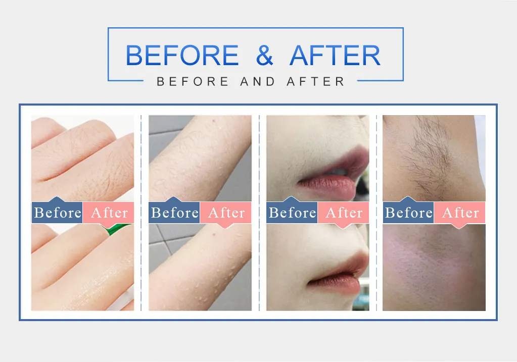 Hair Removal Laser Machine 810 Diode Laser Hair Removal Machine
