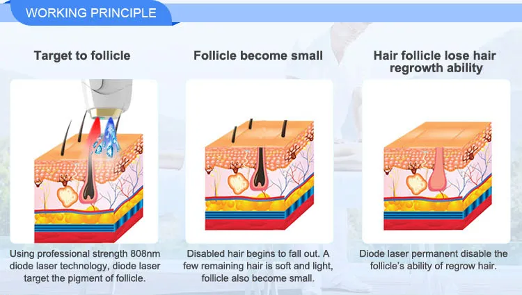 808nm Diodes Laser Hair Removal 755 808 1064