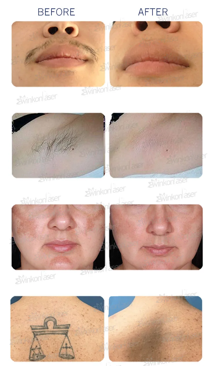 Professional 808nm Hair Removal 1064 755 808 Diode Laser Machine