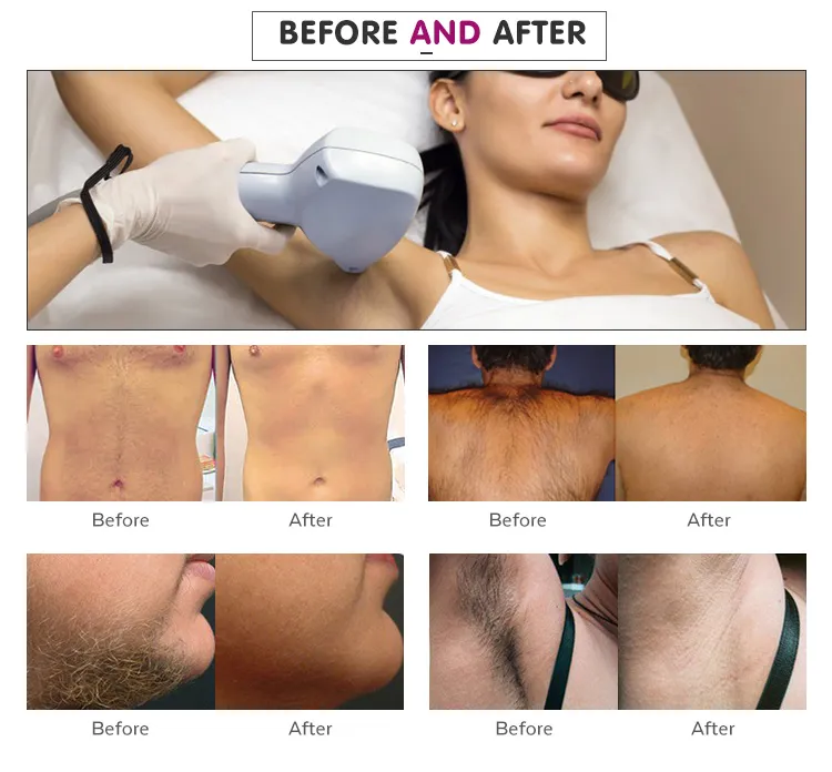 Portable 808nm Laser Permanent Hair Removal Machine 808nm Diode Laser Ce Approved
