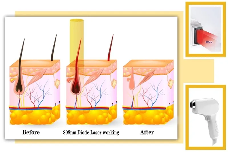FDA Ce Approved 808nm Diode Laser Hair Removal Machine/Alexandrite Laser Hair Removal
