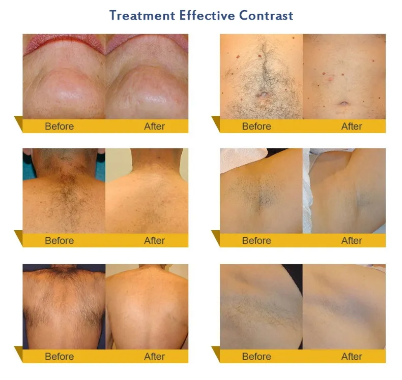 Effective Painless 1200W 808nm Three Wavelength Diode Laser Hair Removal Machine
