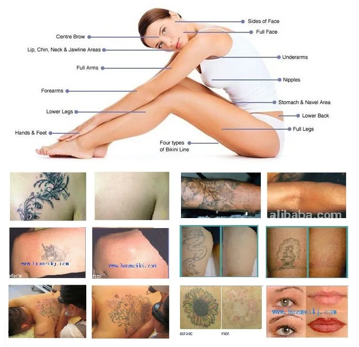 Newest Tattoo Removal Laser Q Switched ND YAG Laser